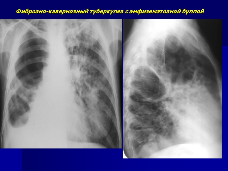 Фиброзно-кавернозный туберкулез с эмфизематозной буллой